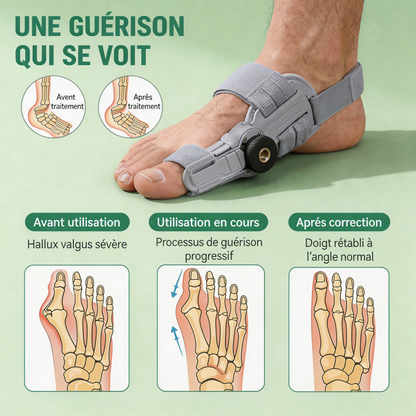 Correcteur Hallux Valgus Articulé PODALYCE®